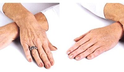 Rejuvenarea dosului mâinilor prin injectarea de grăsime proprie