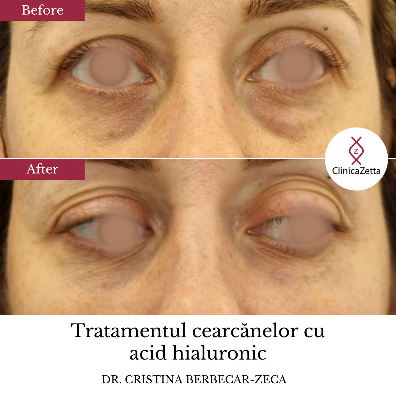 acid hialuronic cearcane